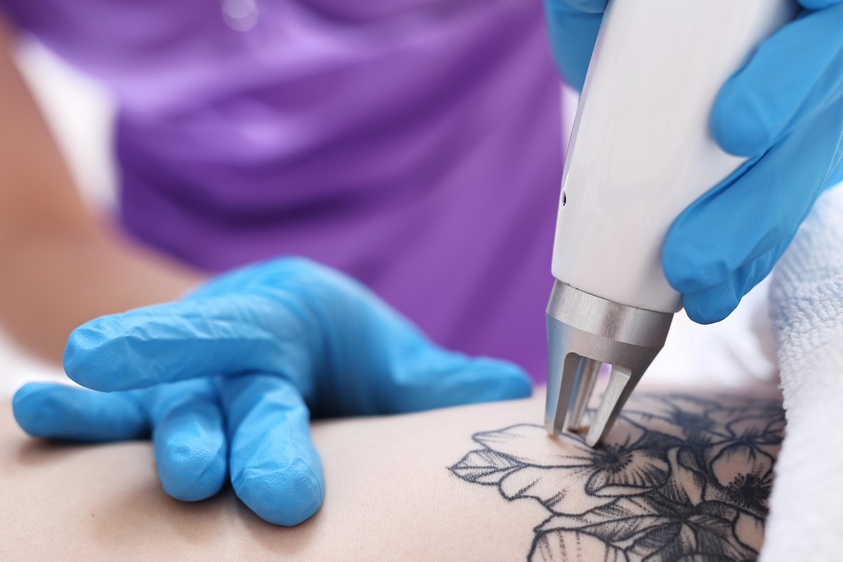 TriVantage Tattoo Removal/Laser
