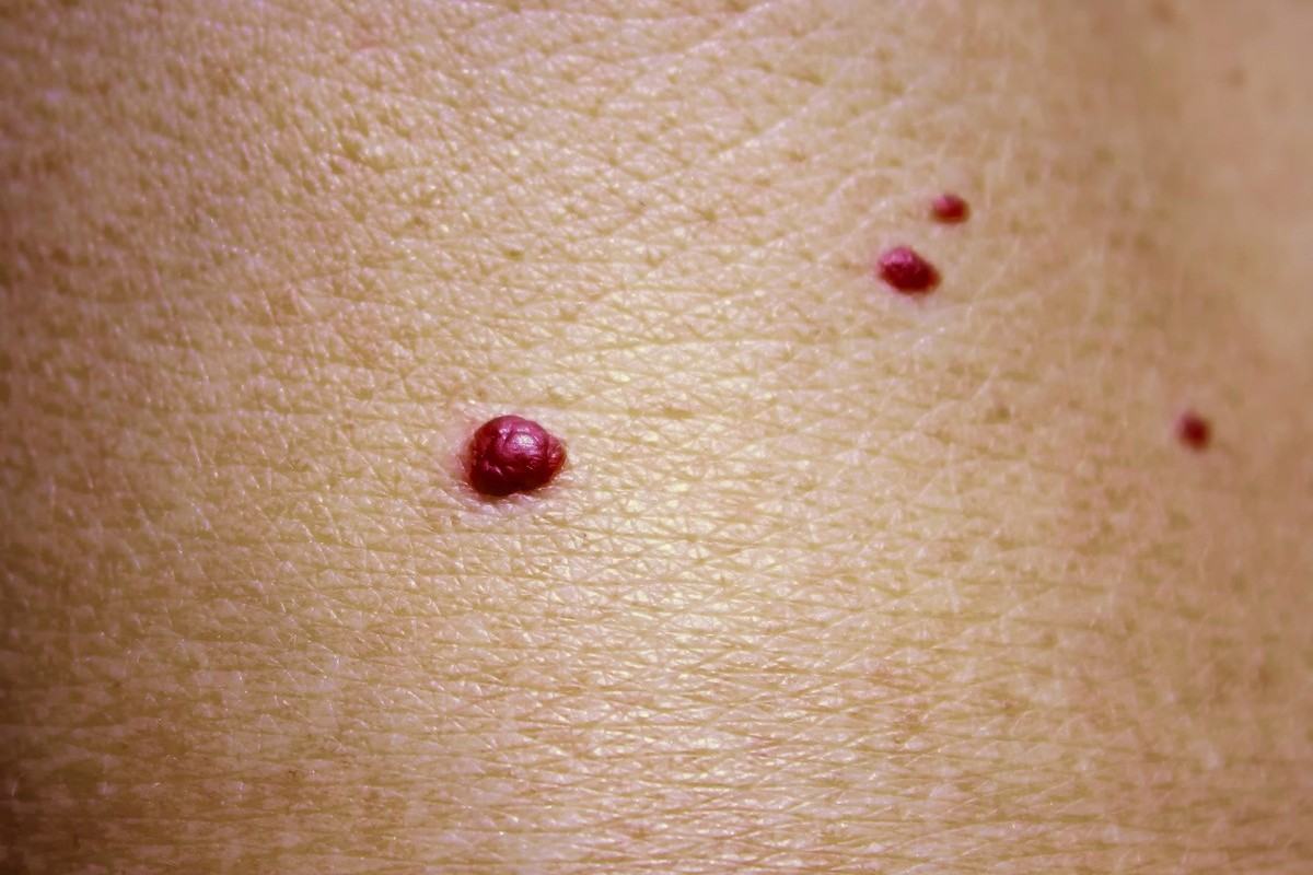Cherry Angiomas