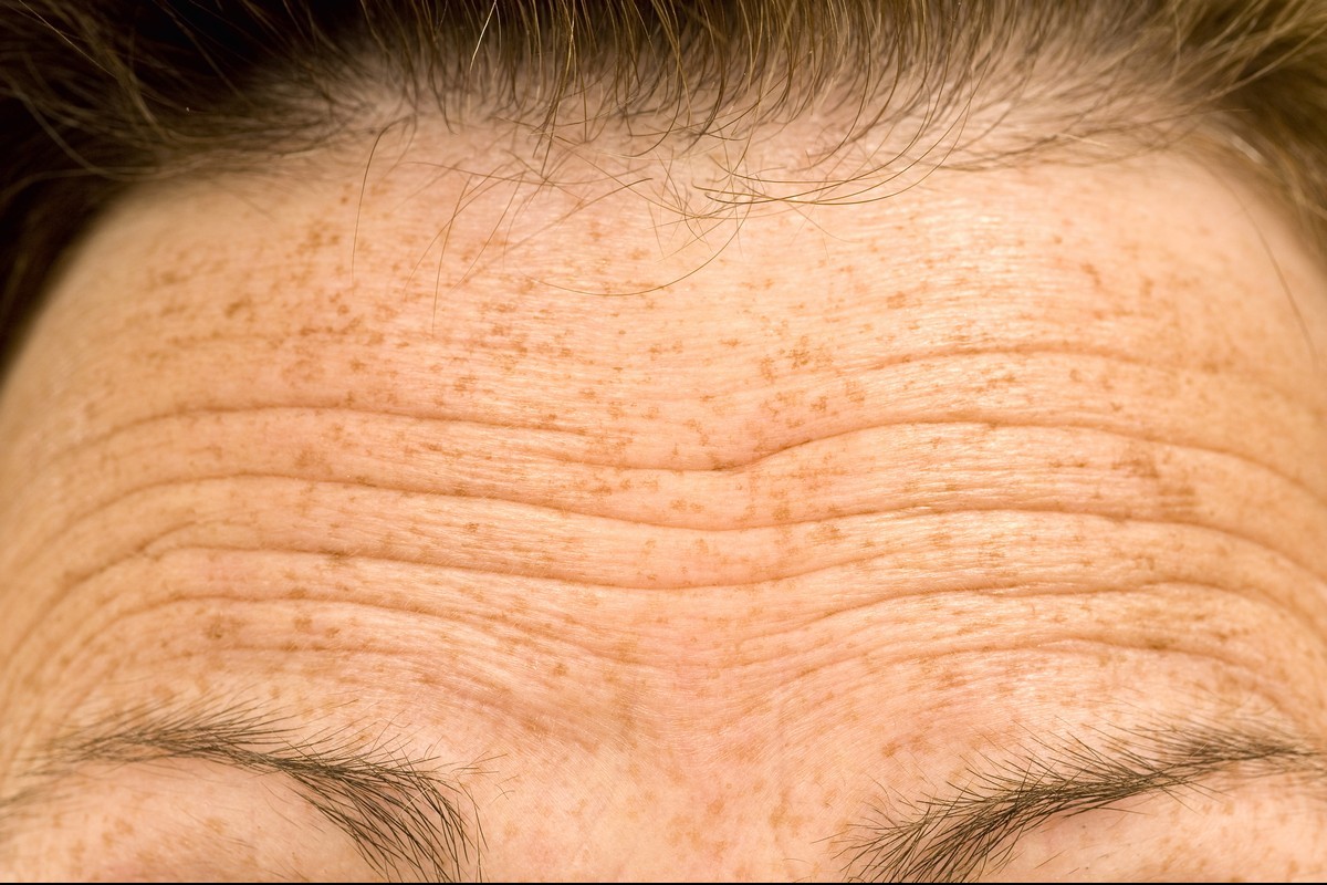 Forehead Lines